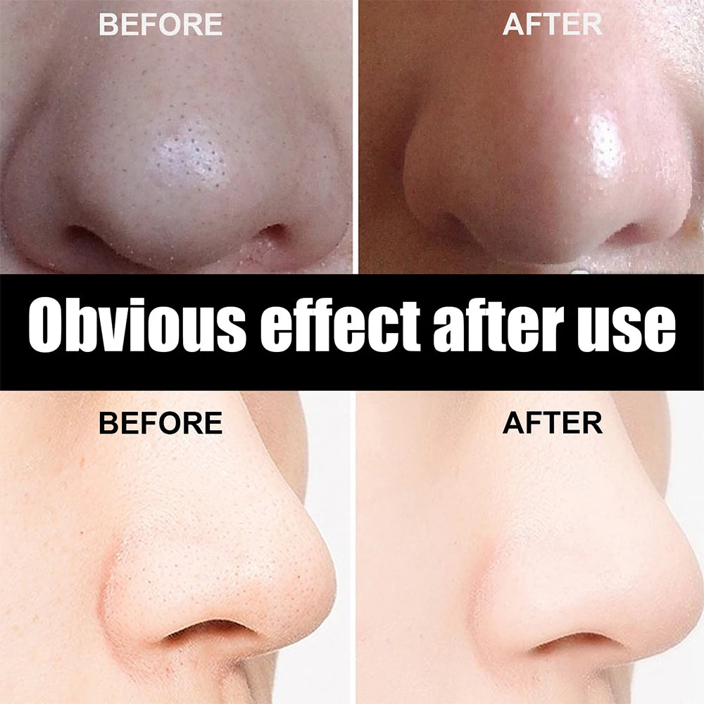 10 tiras nasales unisex para eliminar puntos negros, mascarilla para el cuidado de la piel, parches para limpiar los poros y eliminar puntos negros.