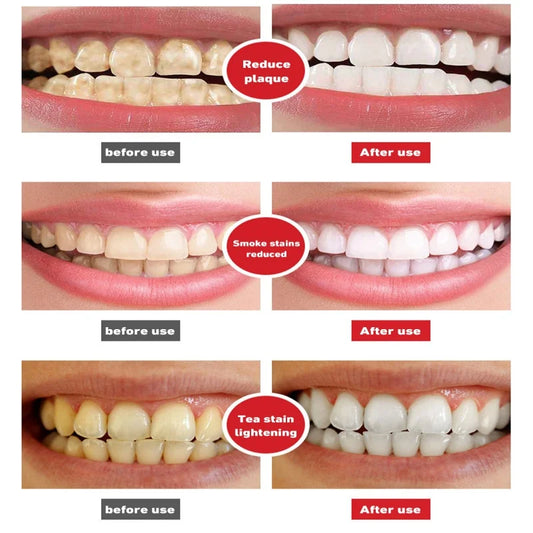 Pasta dental probiótica para caries, reparación rápida, limpieza, blanqueamiento, elimina placa amarilla, protege encías, reduce manchas dentales y deja un aliento fresco.