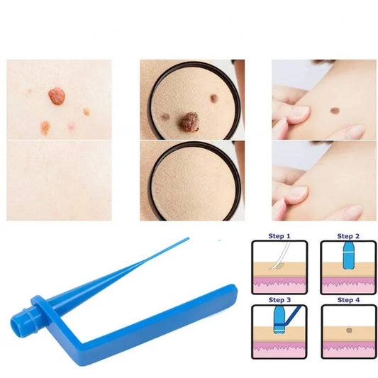 Kit para eliminar verrugas y lunares, microbanda, herramientas de tratamiento con hisopos limpiadores.