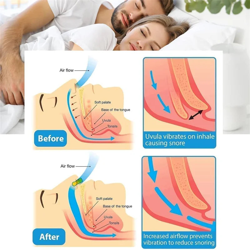 Dispositivo antirronquidos para mujeres, pinza nasal para eliminar ronquidos, pinza nasal para hombres, sueño nocturno 