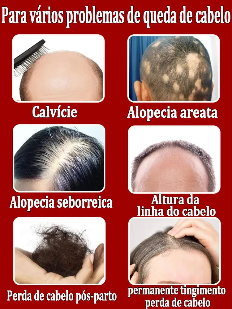 Este é absolutamente o produto para crescimento capilar mais eficaz do século XXI, que ajudou milhões de pessoas a se livrar da queda de cabelo e da calvície, 100% eficaz.