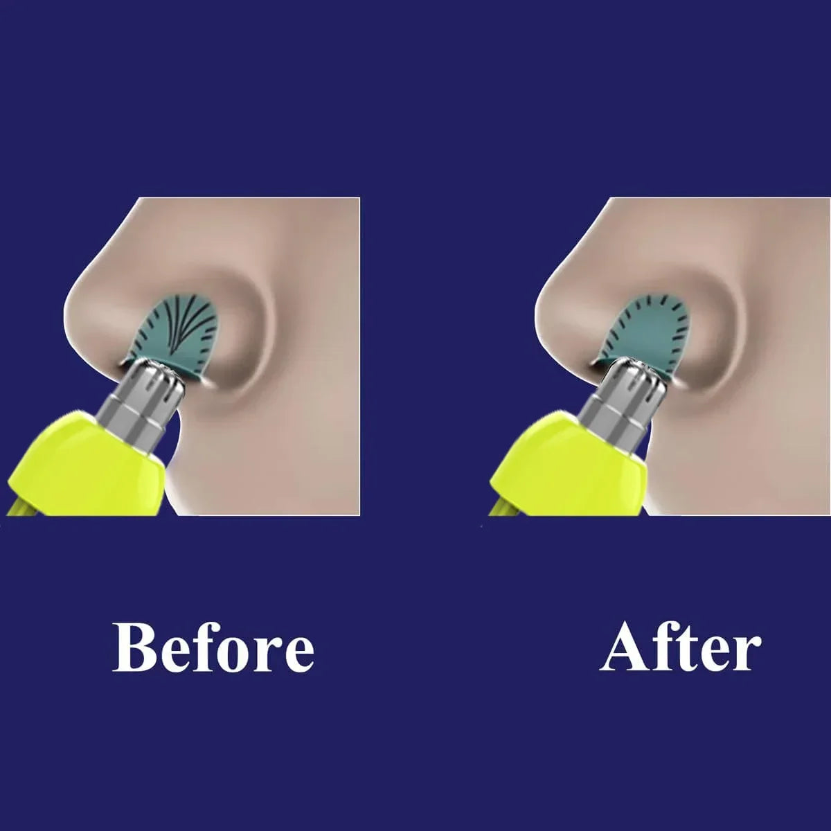 Nose Hair Trimmer Replacement Heads for Philips One Blade QP2520 QP2630 QP2724 QP6510 QP6520 QP6530 Hybrid Electric Shaver