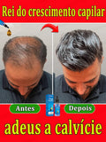 Este é absolutamente o produto para crescimento capilar mais eficaz do século XXI, que ajudou milhões de pessoas a se livrar da queda de cabelo e da calvície, 100% eficaz.