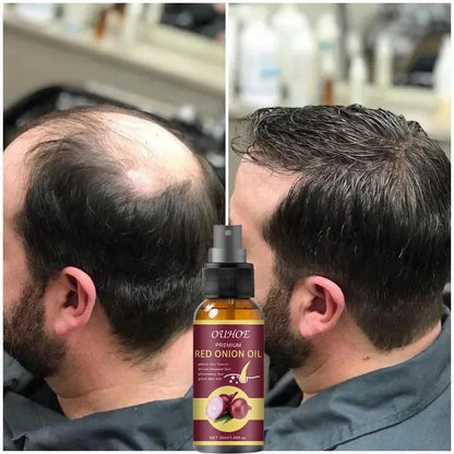 Suero en spray para el crecimiento del cabello, tratamiento anticaída, esencia reparadora, nutre las raíces y rebrota el cabello, cuidado de belleza para hombres. 