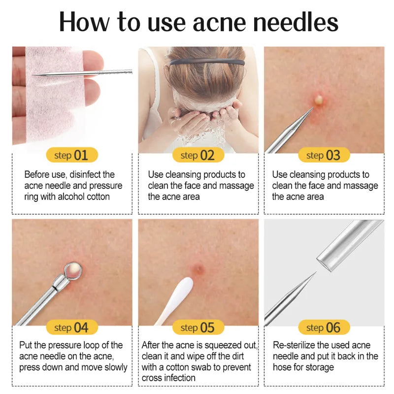 1PC Acne Clip Set Cell Clip Acne Needle Squeezing Blackhead Pressing Rod Cleaning Facial Stainless Steel Beauty Tool