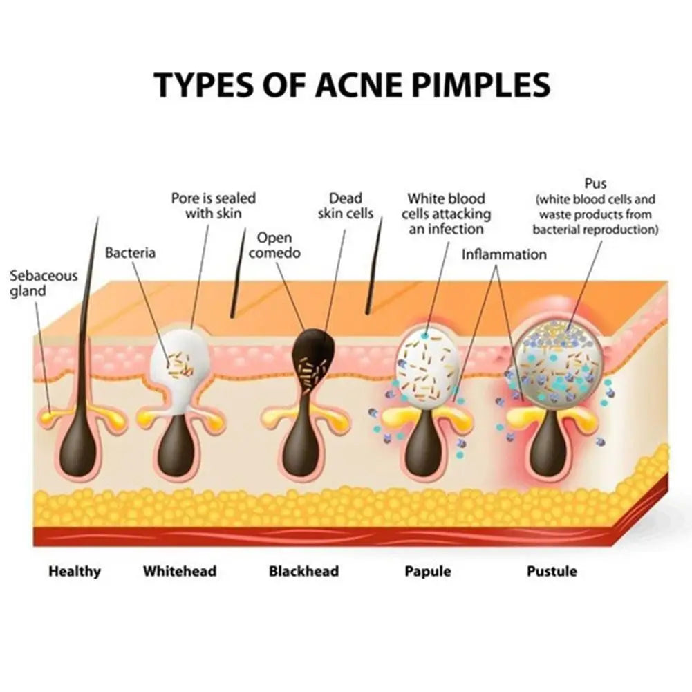 5pcs/lot Blackhead Remover Stickers Nasal Patch Deep Cleaning Shrink Pores Acne Treatment Nose Blackhead Mask Strips Skin Care