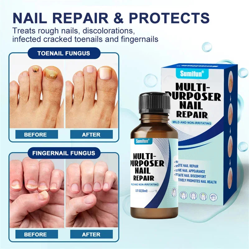 Fungal Nail Tratamento Soro, Foot Care Essence, Fungus Removal Repair Gel, Paroníquia Anti Infecção e Onicomicose