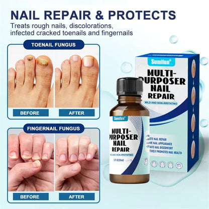 Fungal Nail Tratamento Soro, Foot Care Essence, Fungus Removal Repair Gel, Paroníquia Anti Infecção e Onicomicose