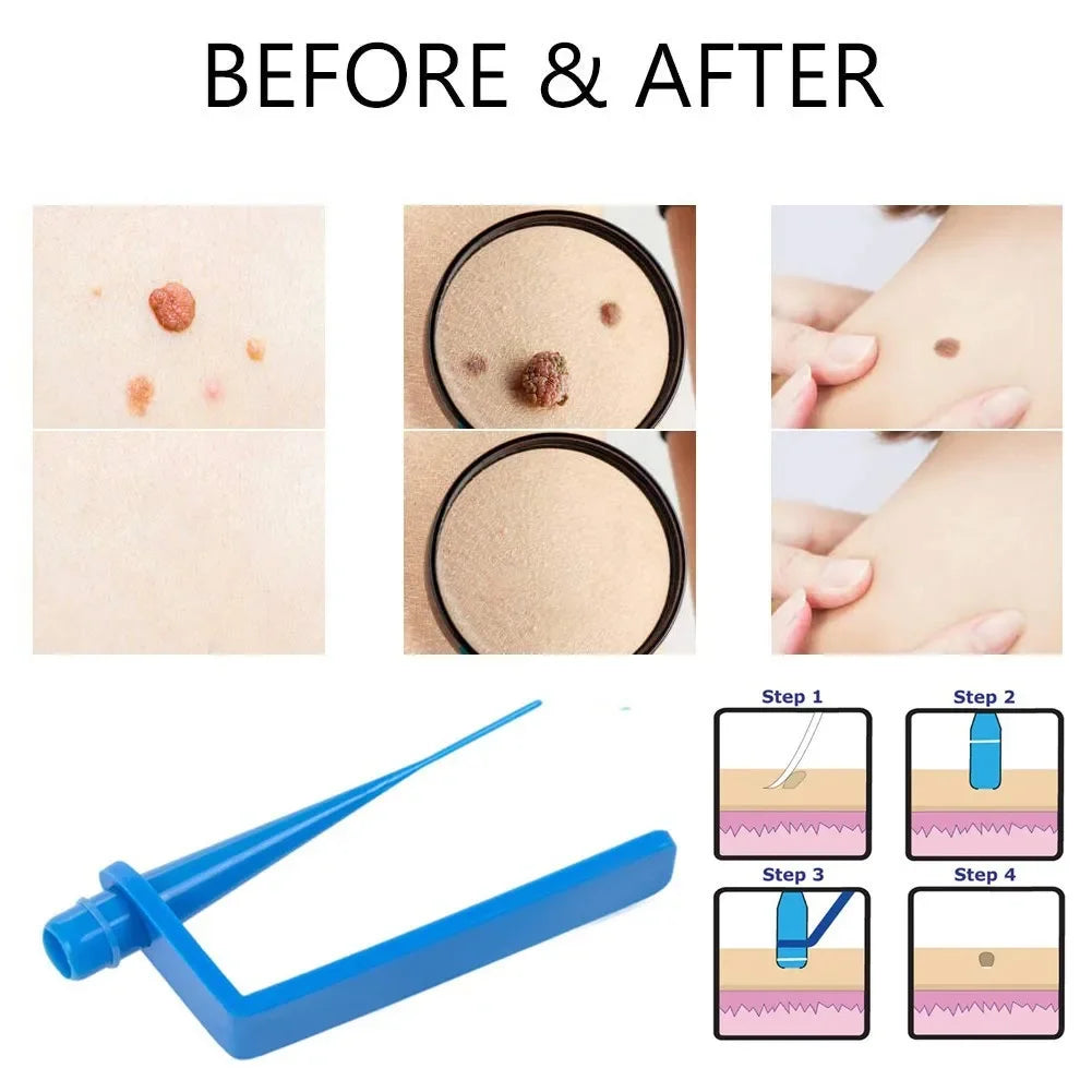 Skin Tag Removal Kit Skin Mole Wart Remover Micro Band Skin Tag Removal Kit Treatment Tools Set With Cleansing Swabs