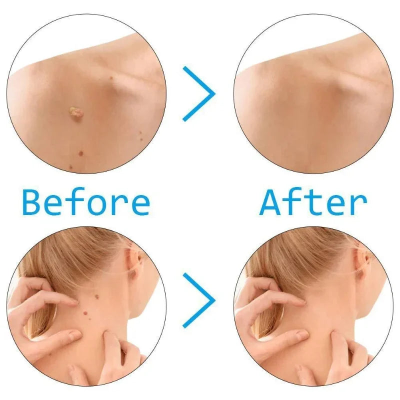 Skin Tag Removal Kit Skin Mole Wart Remover Micro Band Skin Tag Removal Kit Treatment Tools Set With Cleansing Swabs
