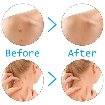 Skin Tag Removal Kit Skin Mole Wart Remover Micro Band Skin Tag Removal Kit Treatment Tools Set With Cleansing Swabs