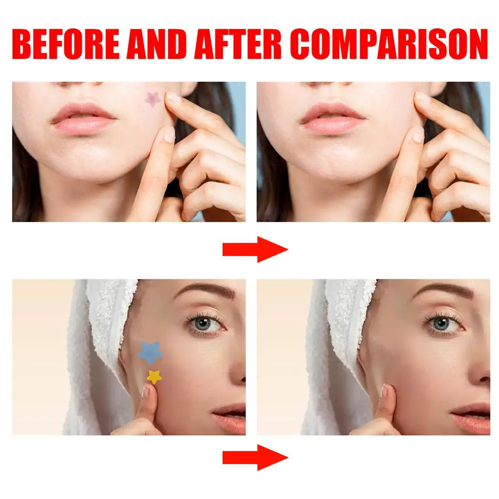 200pcs Colorful Star-Shaped Hydrocolloid Invisible Pimple Patches For Face, Cute Zit Cover Stickers Skin Care