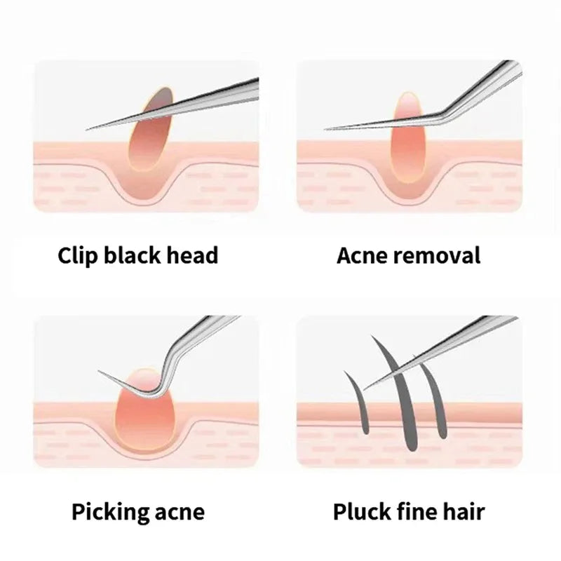 Acne Needle Tweezers Light Blackhead Blemish Pimples Removal Pointed Bend Head Face Care Tools Acne Extractor Beauty-health