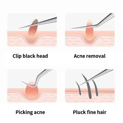 Acne Needle Tweezers Light Blackhead Blemish Pimples Removal Pointed Bend Head Face Care Tools Acne Extractor Beauty-health