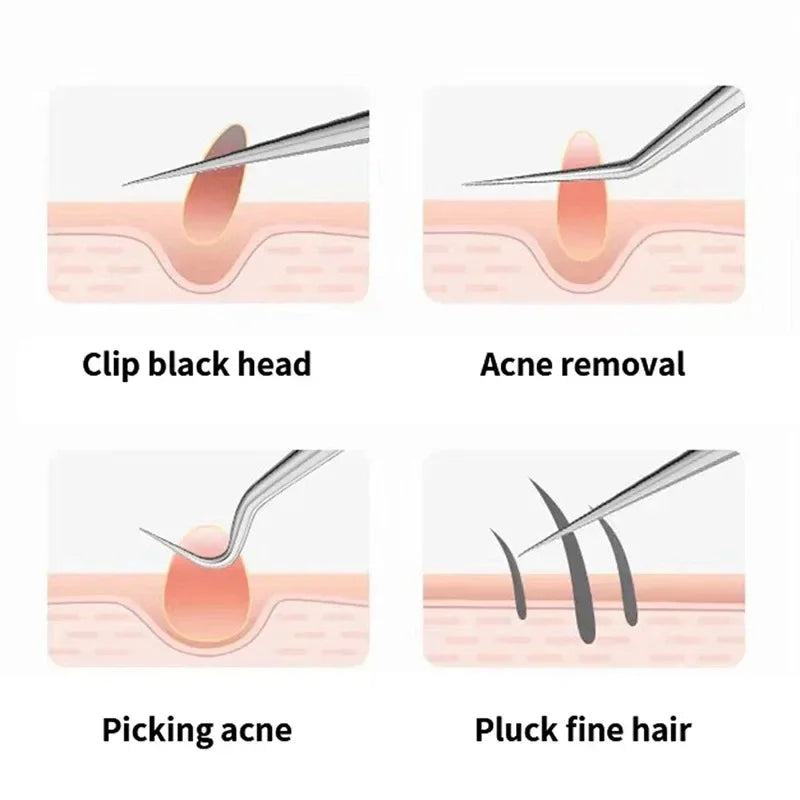 Acne Needle Tweezers Light Blackhead Blemish Pimples Removal Pointed Bend Head Face Care Tools Acne Extractor Beauty-health