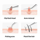 Acne Needle Tweezers Light Blackhead Blemish Pimples Removal Pointed Bend Head Face Care Tools Acne Extractor Beauty-health
