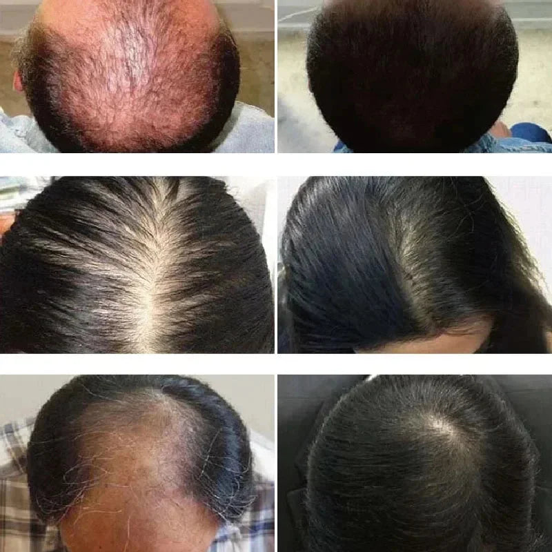 Suero en spray para el crecimiento del cabello, tratamiento anticaída, esencia reparadora, nutre las raíces y rebrota el cabello, cuidado de belleza para hombres. 