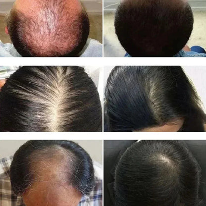 Suero en spray para el crecimiento del cabello, tratamiento anticaída, esencia reparadora, nutre las raíces y rebrota el cabello, cuidado de belleza para hombres. 