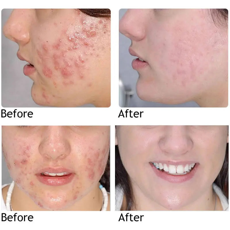 Original Green Tea Deep Remove Blackheads Acne Mud Mask Stick Shrink Pores Dispel Acne Cream Treat Pimple Korean Clean Skin Care