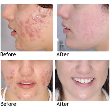 Original Green Tea Deep Remove Blackheads Acne Mud Mask Stick Shrink Pores Dispel Acne Cream Treat Pimple Korean Clean Skin Care