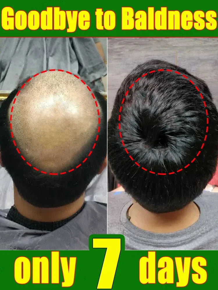 Suero en spray para el crecimiento del cabello, tratamiento anticaída, esencia reparadora, nutre las raíces y rebrota el cabello, cuidado de belleza para hombres. 