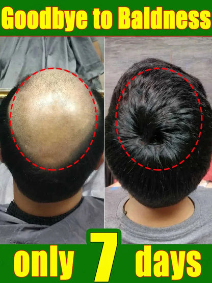 Suero en spray para el crecimiento del cabello, tratamiento anticaída, esencia reparadora, nutre las raíces y rebrota el cabello, cuidado de belleza para hombres. 