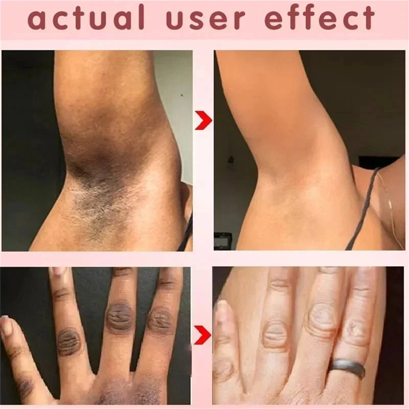Crema blanqueadora para partes íntimas, suero blanqueador de axilas, blanquea glúteos y rodillas, aclara la parte interna del muslo, oscurece las partes íntimas y elimina la melanina.