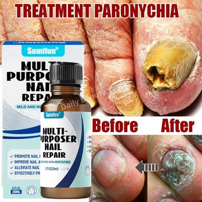 Fungal Nail Tratamento Soro, Foot Care Essence, Fungus Removal Repair Gel, Paroníquia Anti Infecção e Onicomicose