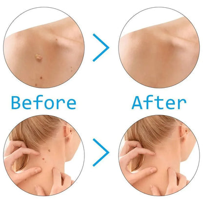 Skin Tag Removal Kit Skin Mole Wart Remover Micro Band Skin Tag Removal Kit Treatment Tools Set With Cleansing Swabs