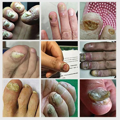 Fungal Nail Tratamento Soro, Foot Care Essence, Fungus Removal Repair Gel, Paroníquia Anti Infecção e Onicomicose