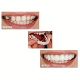 4pcs Comfortable & Flexible White Dentures with Easy-to-Wear Upper and Lower Alveolar Attachment -